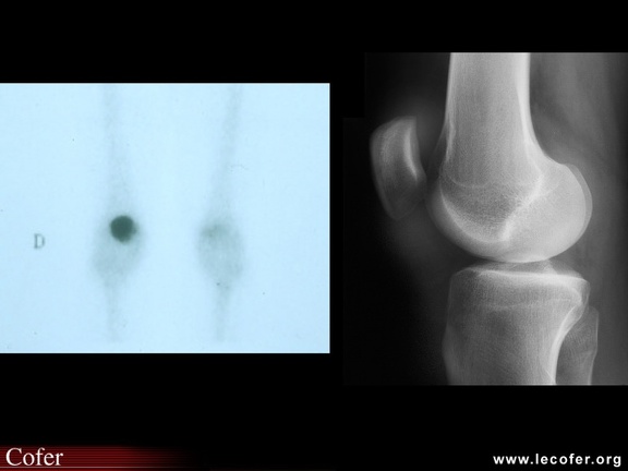 Enthésite rotulienne (patellaire) de spondyloarthrite: intérêt de la scintigraphie