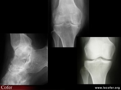 Spondyloarthrite / spondylarthrite ankylosante  / spondylarthropathie : atteinte des pieds et des genoux