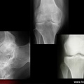 Spondyloarthrite / spondylarthrite ankylosante  / spondylarthropathie : atteinte des pieds et des genoux