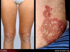 Psoriasis des genoux et des coudes