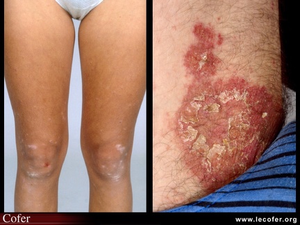 Psoriasis des genoux et des coudes