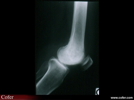 Métastase osseuse d’origine mammaire de localisation épiphysaire