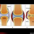 Arthrose: articulation normale vs pathologique