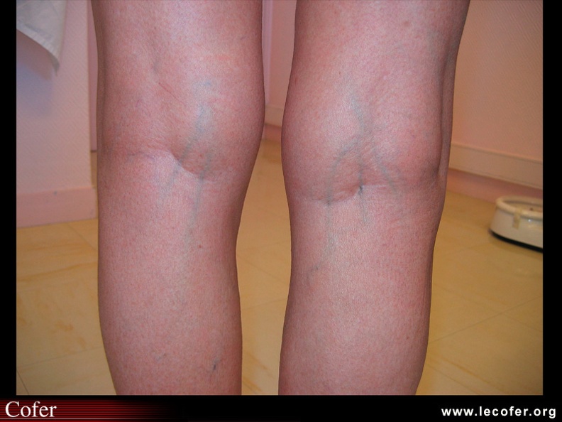 Épanchement de liquide synovial. 070001012.jpg