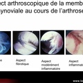 Synovite: vue arthroscopique.