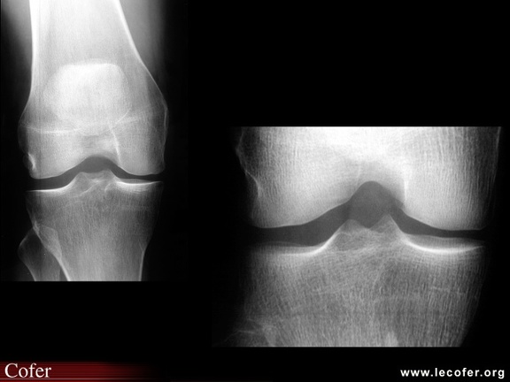 Radiographies normales du genou