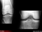 Radiographies normales du genou