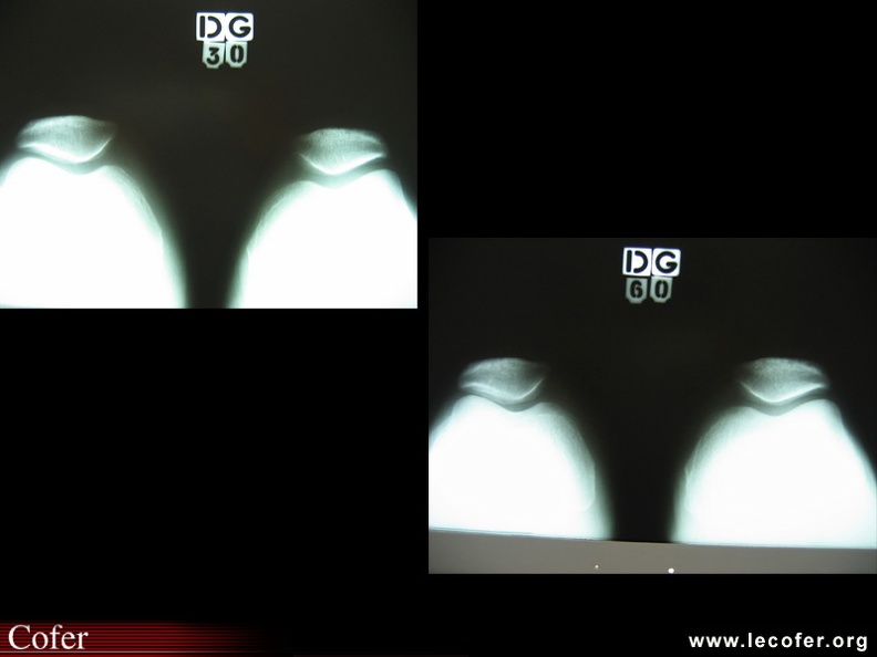 Défilé fémoro-patellaire à différents degrés de flexion : noter la position de la patella engagée dans la trochlée : la facette externe ne déborde pas le bord externe de la trochlée. L’angle de la trochlée ne dépasse pas 120°. 070002020.jpg