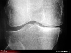 Gonarthrose fémoro-tibiale interne (médiale) évoluée