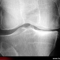 Gonarthrose fémoro-tibiale interne (médiale) évoluée