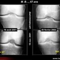 Gonarthrose fémoro-tibiale interne: intérêt du Schuss