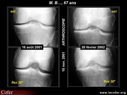 Gonarthrose fémoro-tibiale interne: intérêt du Schuss