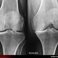 Gonarthrose: intérêt du schuss.