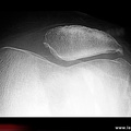 Gonarthrose fémoro-patellaire externe : radiographie