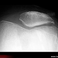Gonarthrose fémoro-patellaire externe : radiographie