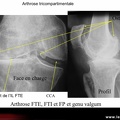 Gonarthrose tricompartimentale