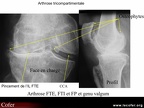 Gonarthrose tricompartimentale