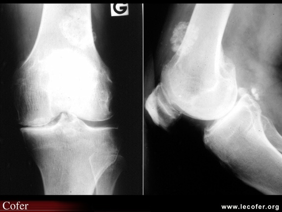 Gonarthrose avec ostéochromatose secondaire