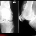 Gonarthrose avec ostéochromatose secondaire