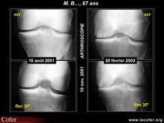 Ostéonécrose primitive du genou et gonarthrose