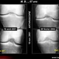 Ostéonécrose primitive du genou et gonarthrose