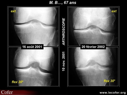 Ostéonécrose primitive du genou et gonarthrose