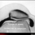 Lésions du cartilage par arthroscanner