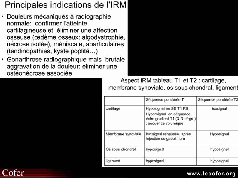 Aspects en T1 et T2 des structures articulaires et indications de l'IRM dans la gonarthrose. 070002039.jpg