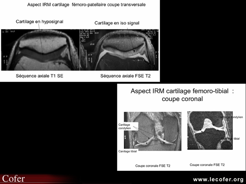 Aspects du cartilage fémoro-tibial et fémoro-patellaire en séquences pondérées en T1 et en T2. 070002040.jpg
