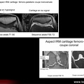 Aspects du cartilage en IRM