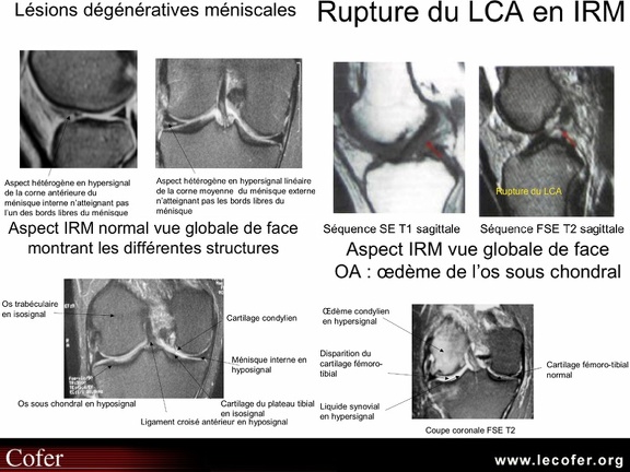 IRM : aspects des structures adjacentes : os sous-chondraux, ménisques, ligaments