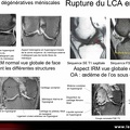 IRM : aspects des structures adjacentes : os sous-chondraux, ménisques, ligaments