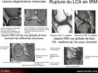 IRM : aspects des structures adjacentes : os sous-chondraux, ménisques, ligaments