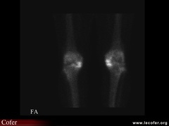 Gonarthrose : aspect scintigraphique