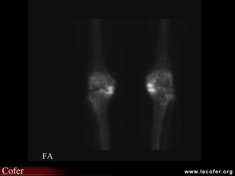 Aspect scintigraphique d'une double gonarthrose fémorotibiale interne. 070002042.jpg