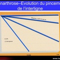 Gonarthrose, profil évolutif de la gonarthrose
