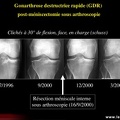 Gonarthrose, profil évolutif de la gonarthrose : forme rapide