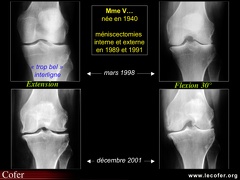 Gonarthrose, profil évolutif de la gonarthrose : forme lente