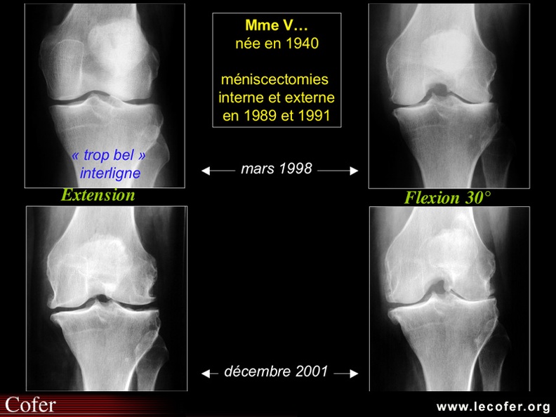 Gonarthrose, profil évolutif de la gonarthrose : forme lente