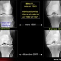 Gonarthrose, profil évolutif de la gonarthrose : forme lente