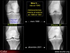 Gonarthrose, profil évolutif de la gonarthrose : forme lente