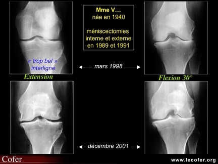 Gonarthrose, profil évolutif de la gonarthrose : forme lente