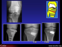 Ostéotomie du genou