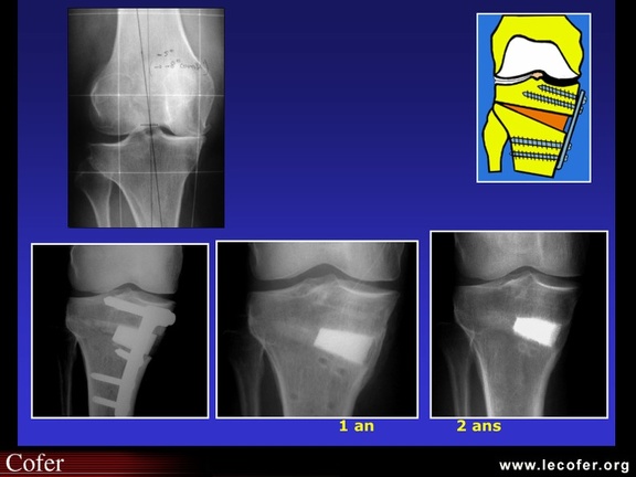 Ostéotomie du genou