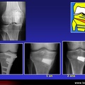 Ostéotomie du genou