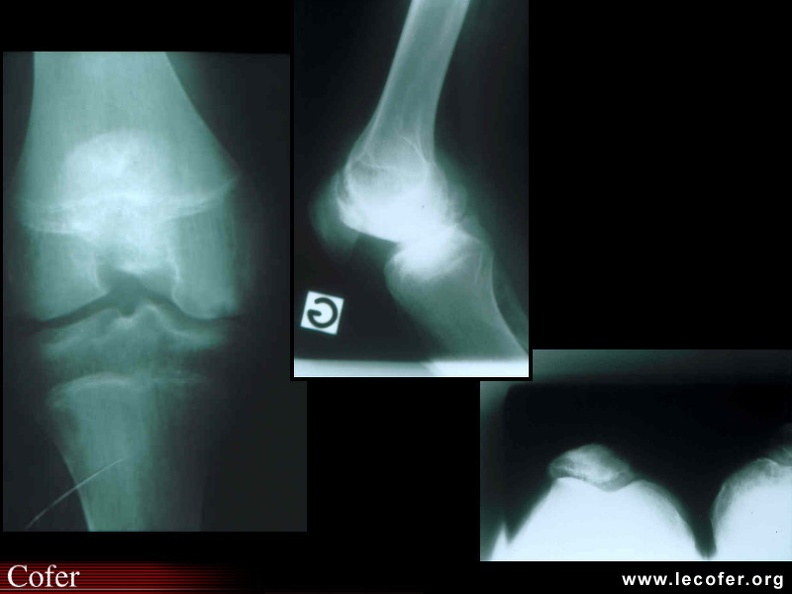 Arthropathie hémophilique du genou chez un adolescent avec lésions érosives d'un condyle, du plateau tibial et de l'articulation fémoro-patellaire. 090200012.jpg