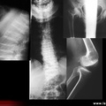 Dysplasie spondylométaphysaire