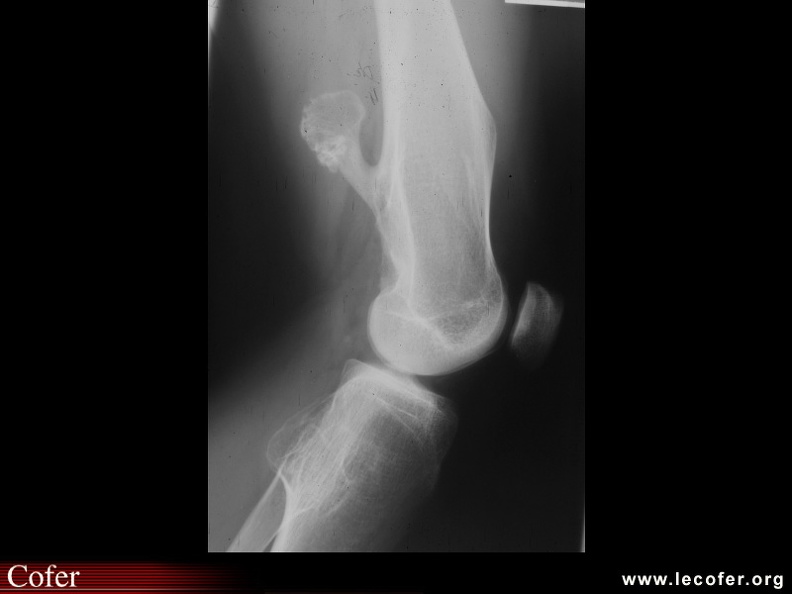 Exostose fémorale (fémur de profil). 090400016.jpg