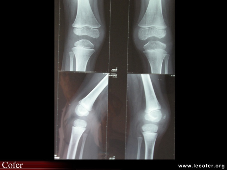 Oligoarthrite : avance de maturation épiphysaire