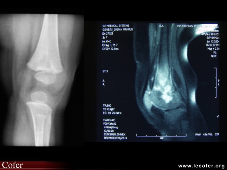 Ostéomyélite infectieuse : radio et IRM